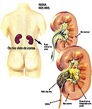 pedra nos rins e o sistema renal